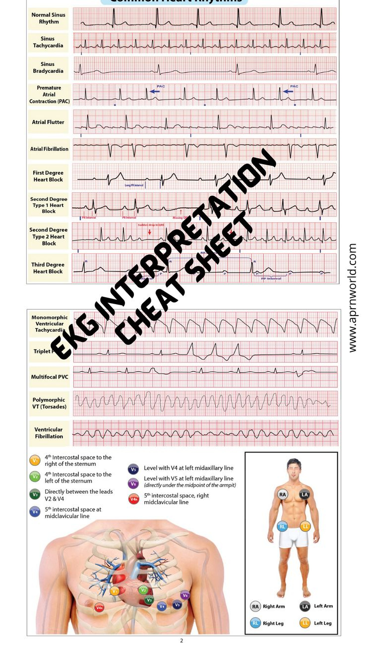 Ekg Interpretation Cheat Sheet - 12 Pages inside Free Printable Ekg Interpretation Cheat Sheet